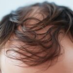 Dlaczego wypadają włosy – najczęstsze przyczyny i sposoby leczenia Dlaczego wypadają włosy