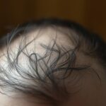 Przy jakim TSH wypadają włosy – co oznaczają wyniki badań Przy jakim tsh wypadają włosy