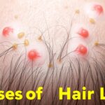 Przyczyna wypadania włosów – jak ją rozpoznać i leczyć Przyczyna wypadania włosów